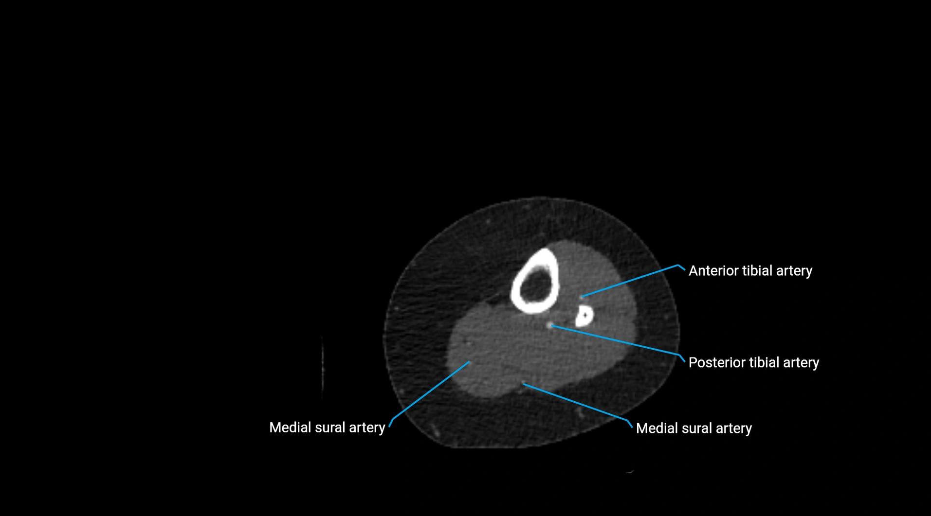 CTA lower limb cross sectional anatomy labelled image _200.webp